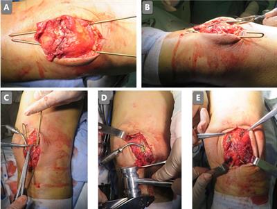 A New Antirotation Strategy of K-Wire Tension Band Therapy for Patellar Fracture